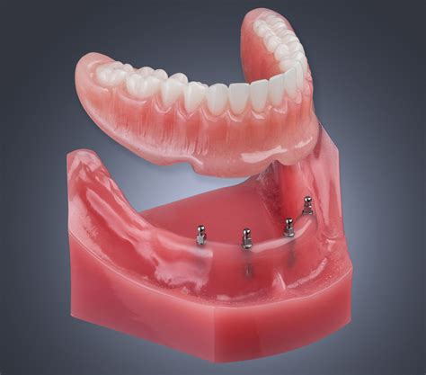 mini dental implants